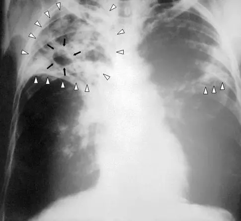 Kansas Confronts Largest Tuberculosis Outbreak in US History